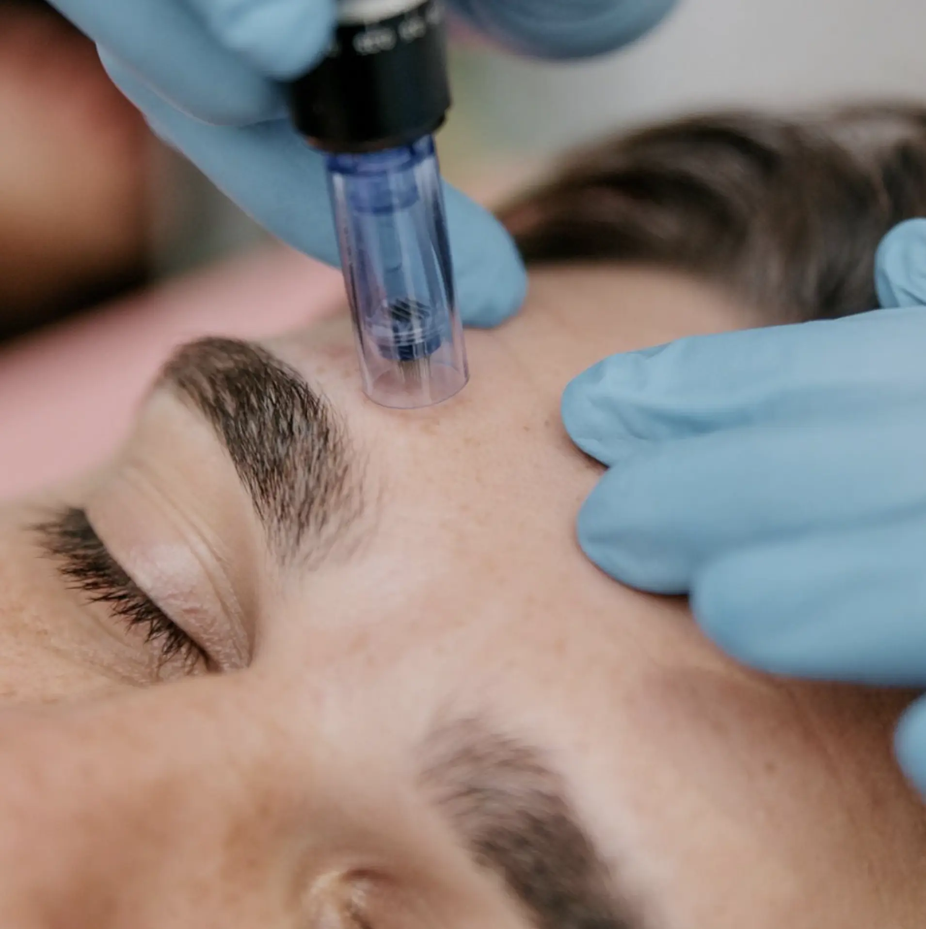 how many skin needling sessions do you need