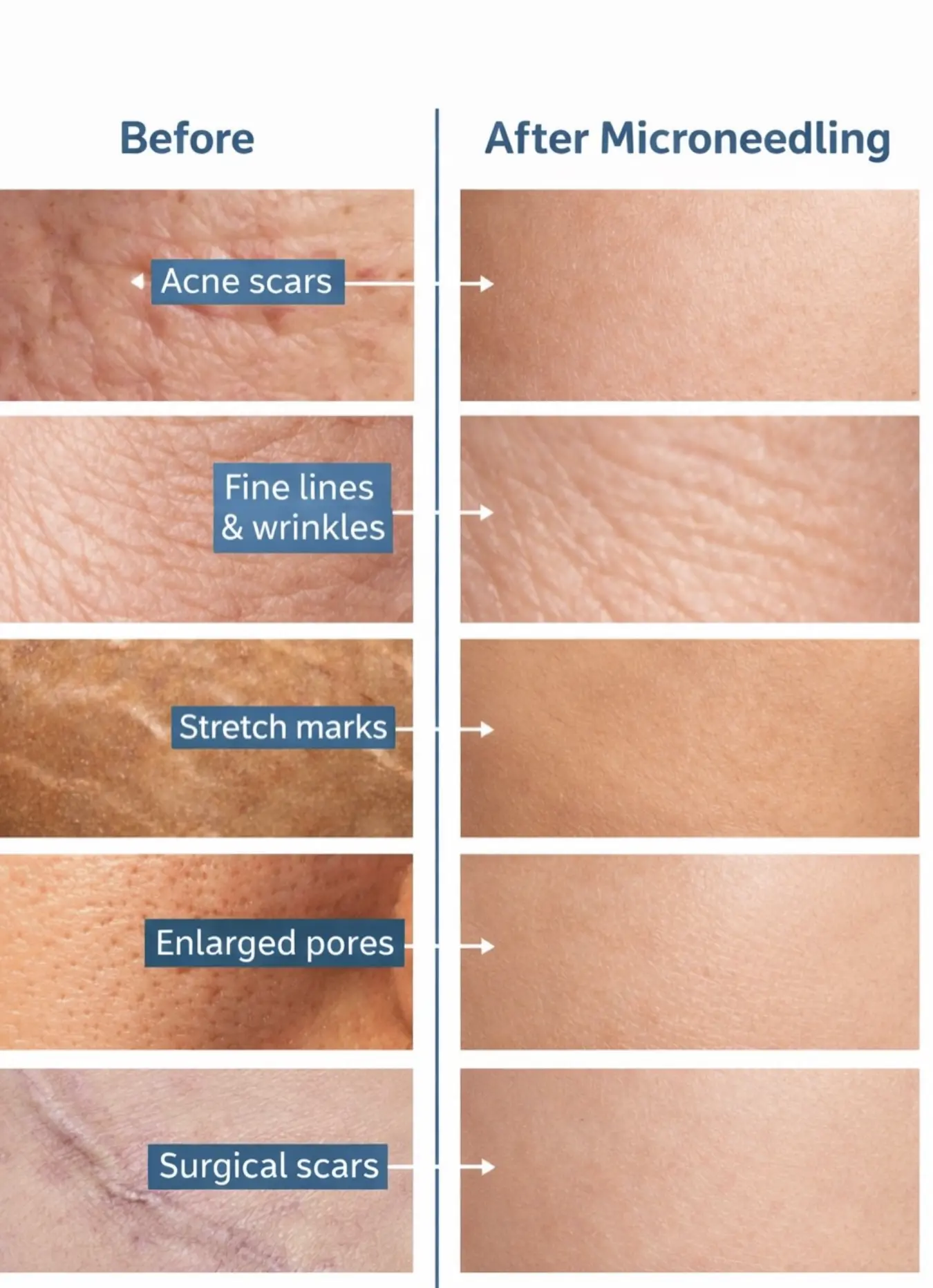 how often do you need skin needling