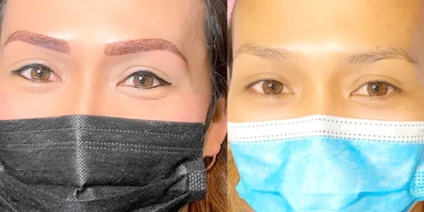 saline tattoo removal melbourne