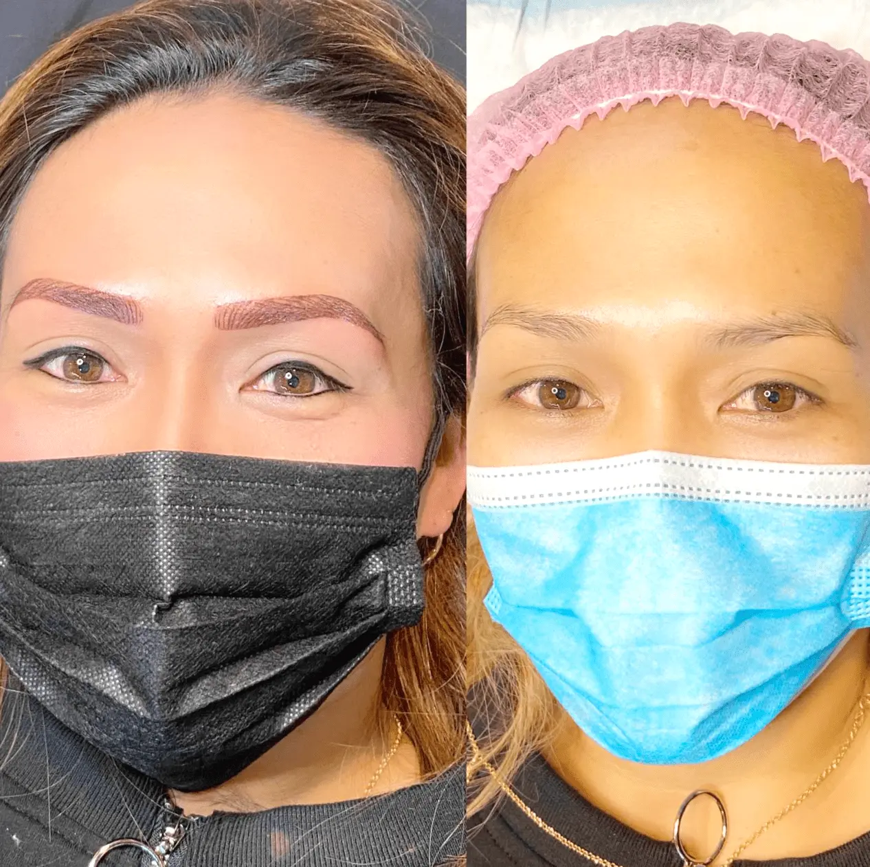 saline tattoo removal melbourne