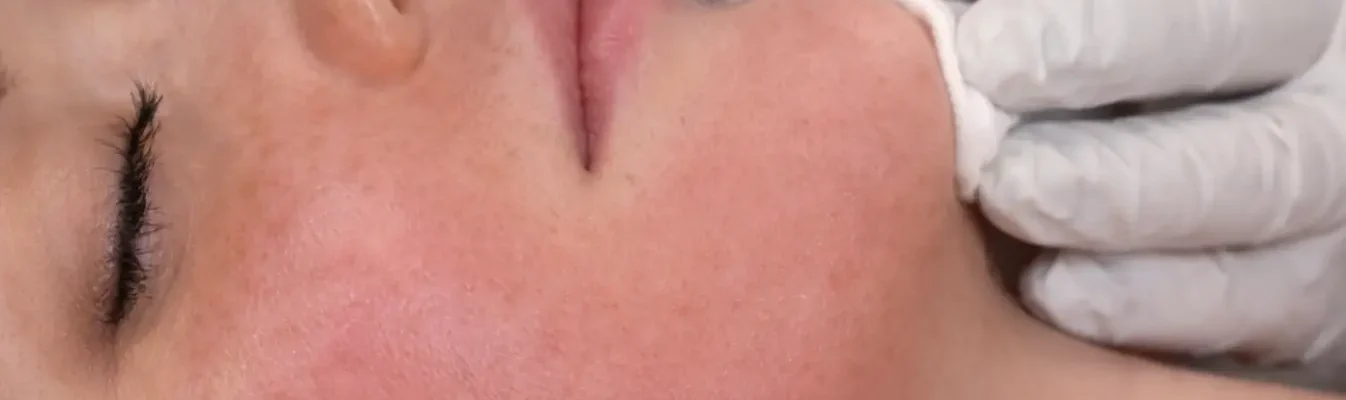 skin microneedling before and after