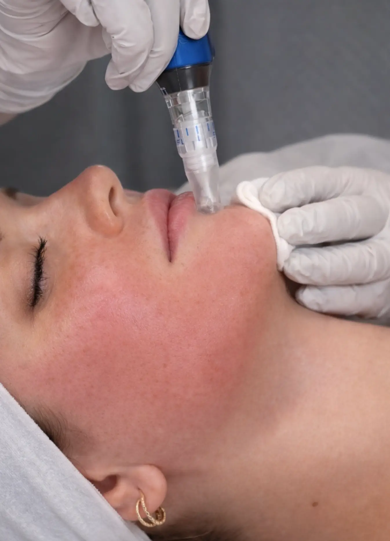 skin microneedling before and after